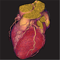 Fig. 2. CardioTC con visualizzazione e ricostruzione 3D delle arterie coronarie
